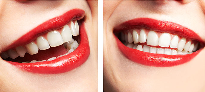 Invisalign in Baltimore