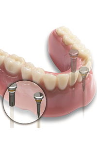 Affordable dentist Maryland MD