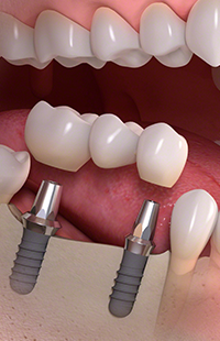 Affordable dental care Baltimore