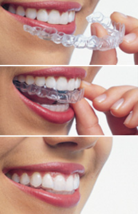 Invisalign Baltimore