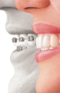 Invisalign Maryland MD