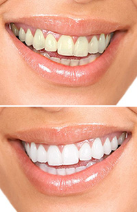  teeth whitening in Maryland MD