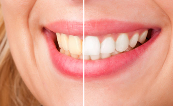 Free teeth whitening Baltimore