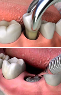 Wisdom Teeth Removal Baltimore
